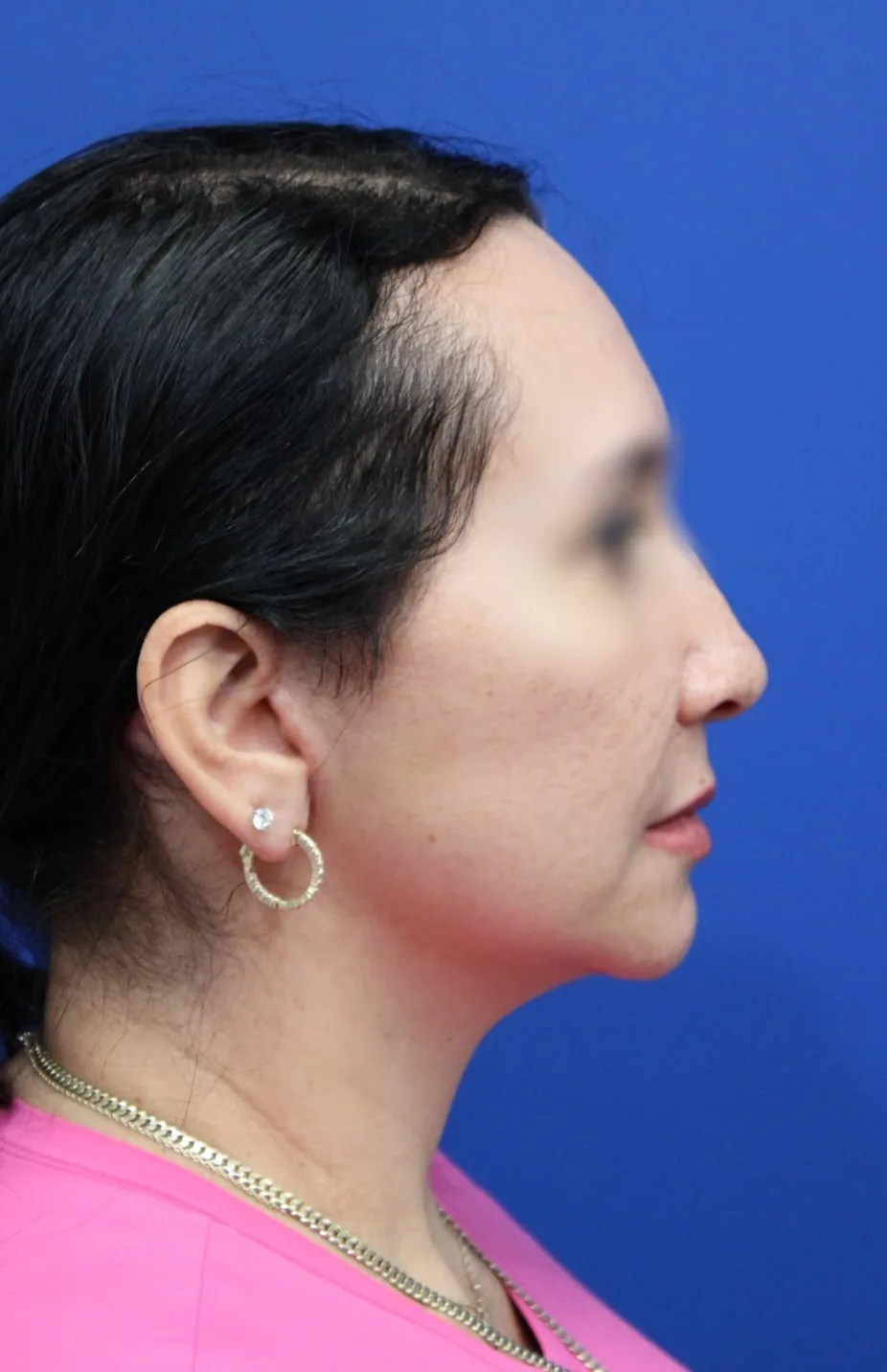 Facelift Before & After Patient #5150