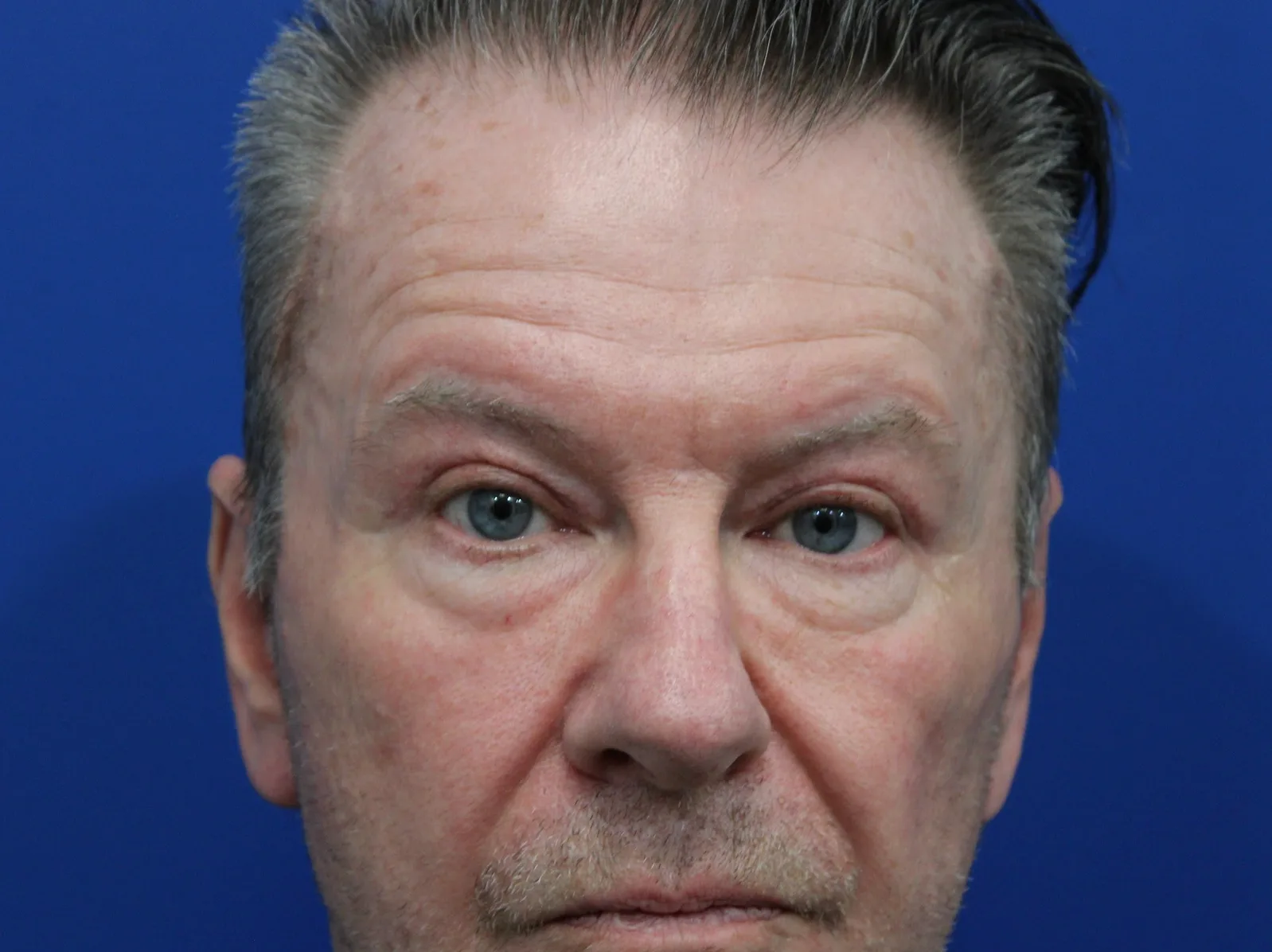 Upper Blepharoplasty Before & After Patient #5147