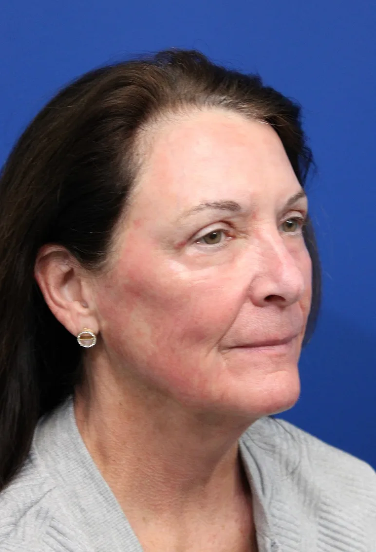 Upper Blepharoplasty Before & After Patient #5193