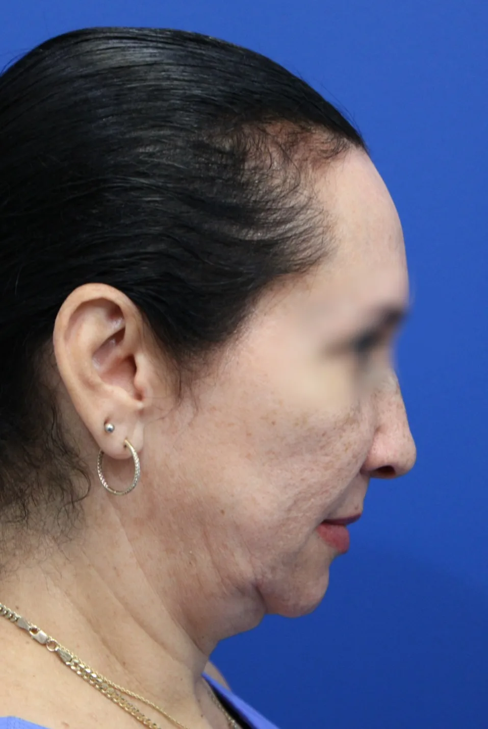 Facelift Before & After Patient #5150