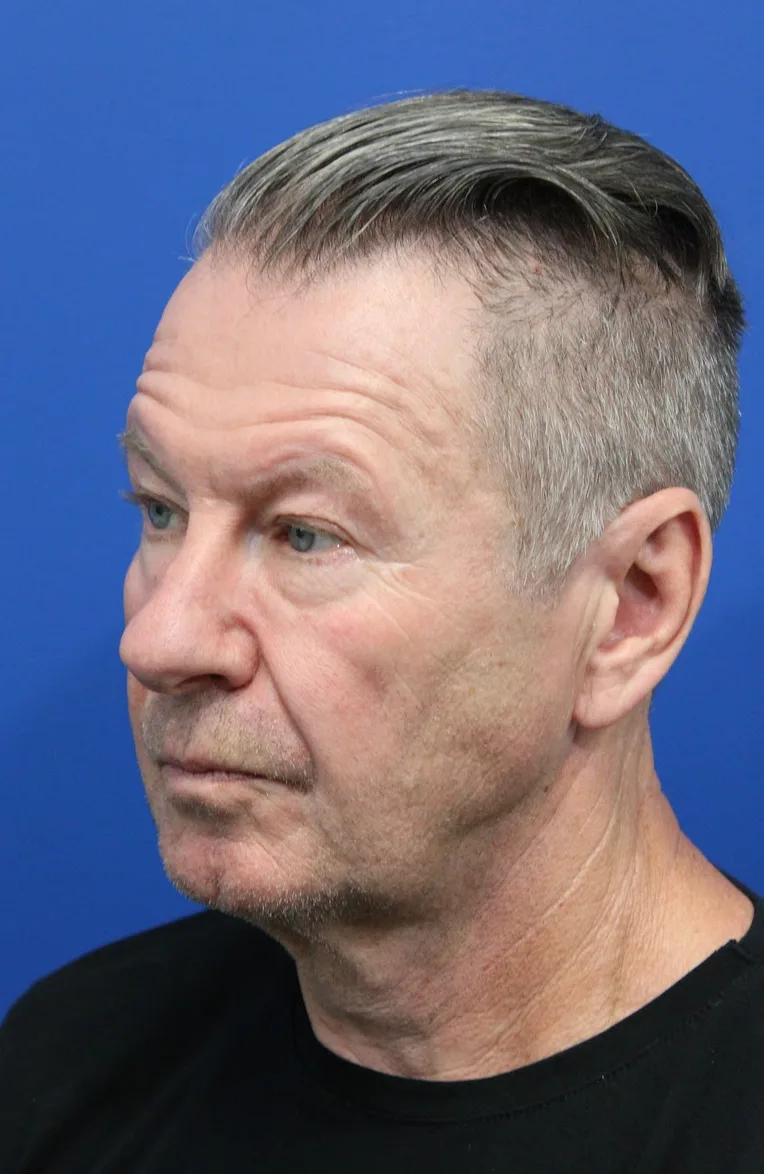 Brow Lift Before & After Patient #5148