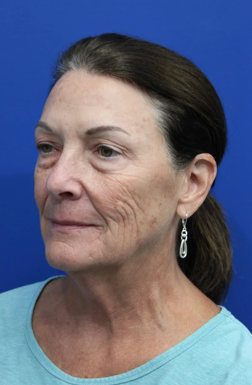 Upper Blepharoplasty Before & After Patient #5193