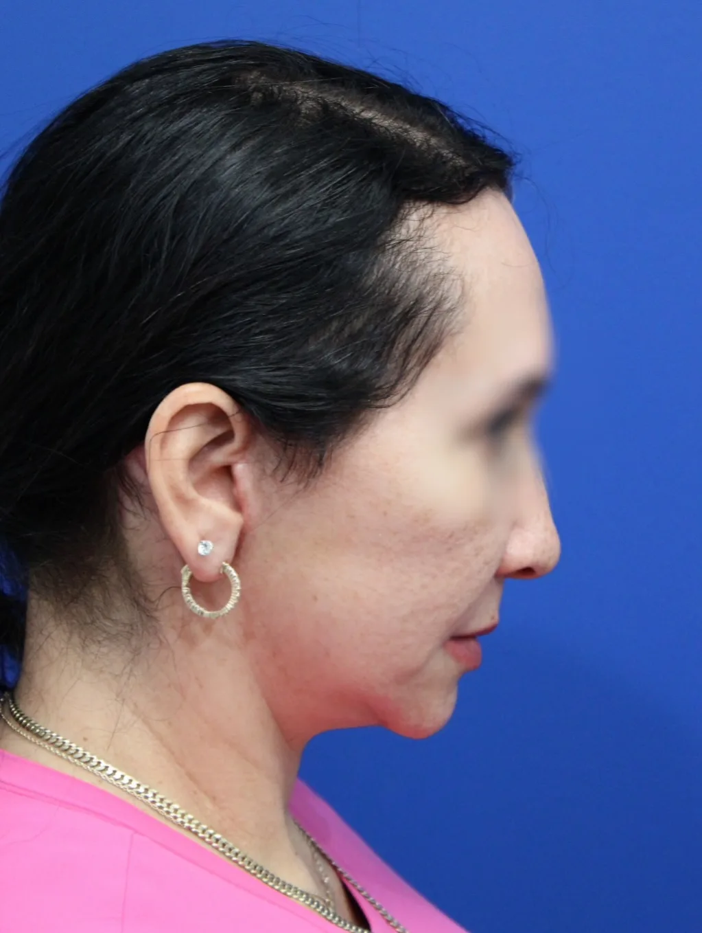 Facelift Before & After Patient #5150