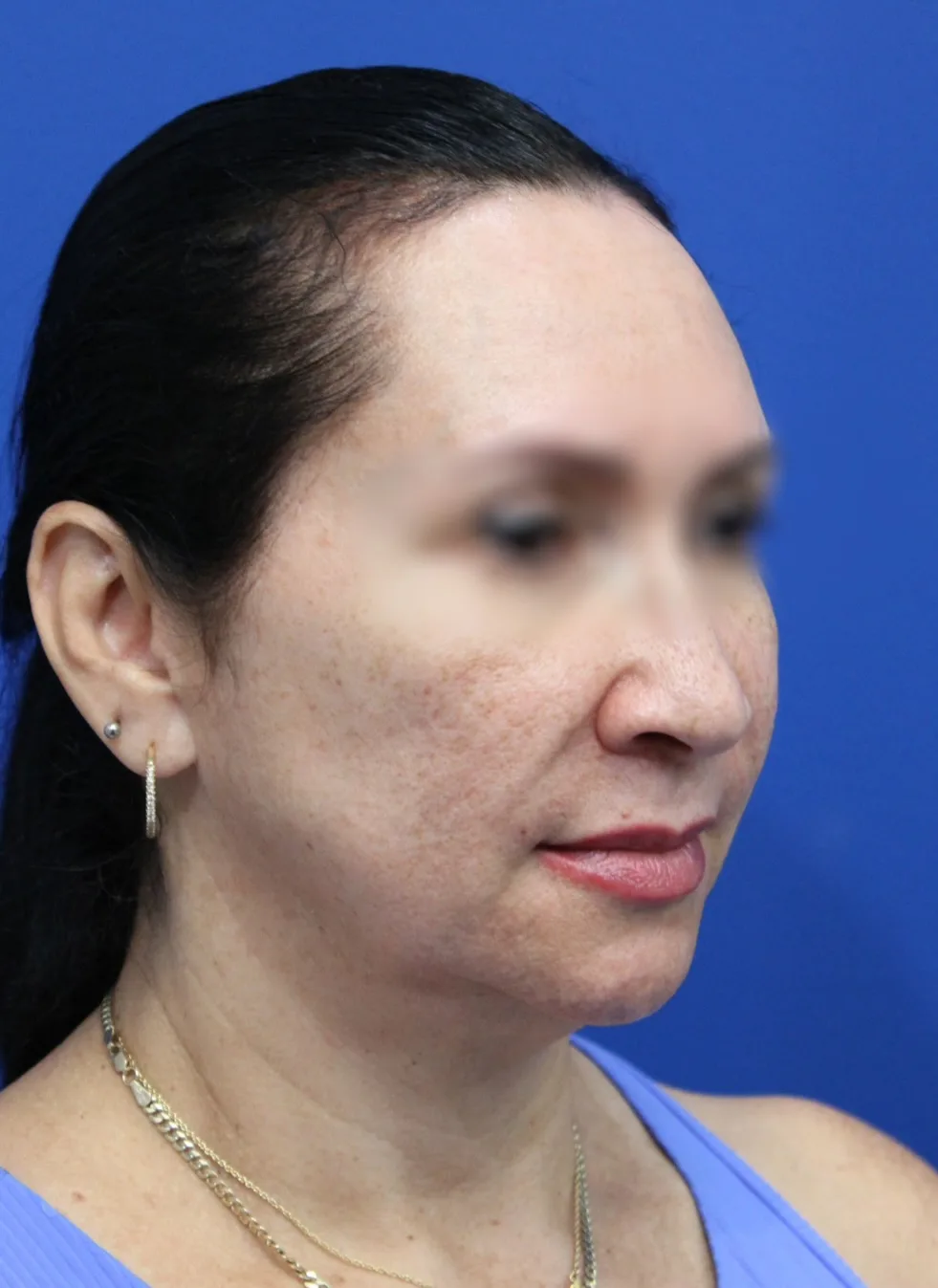 Facelift Before & After Patient #5150