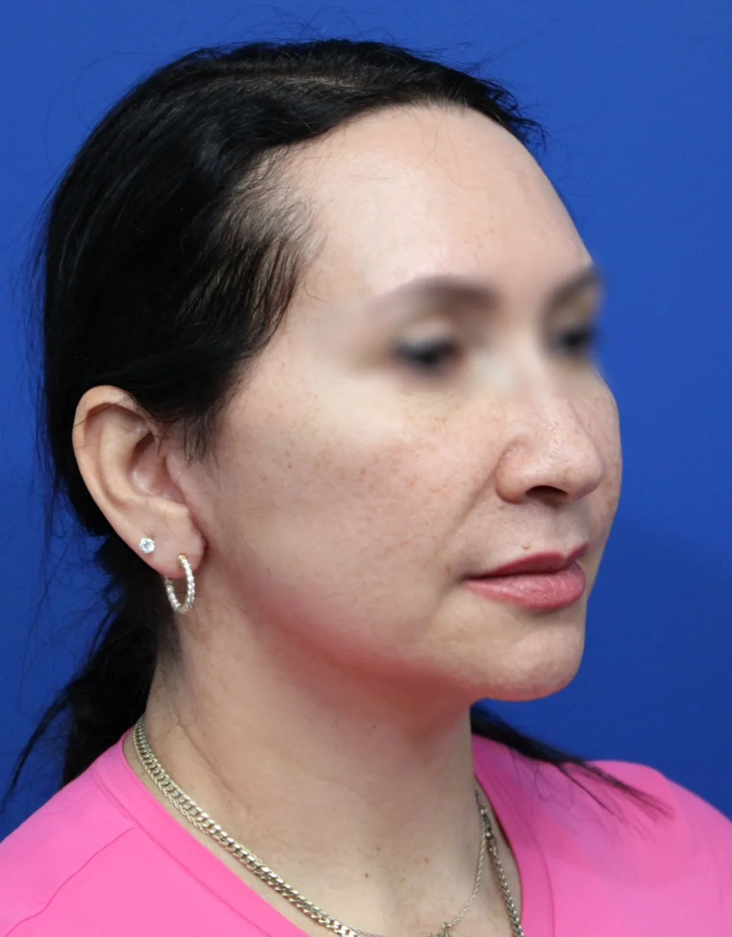 Facelift Before & After Patient #5150