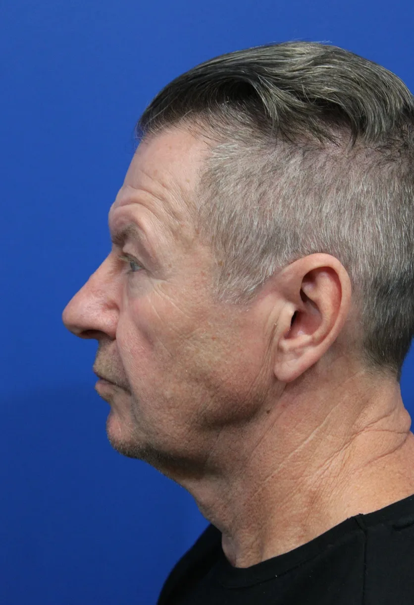 Facelift Before & After Patient #5146