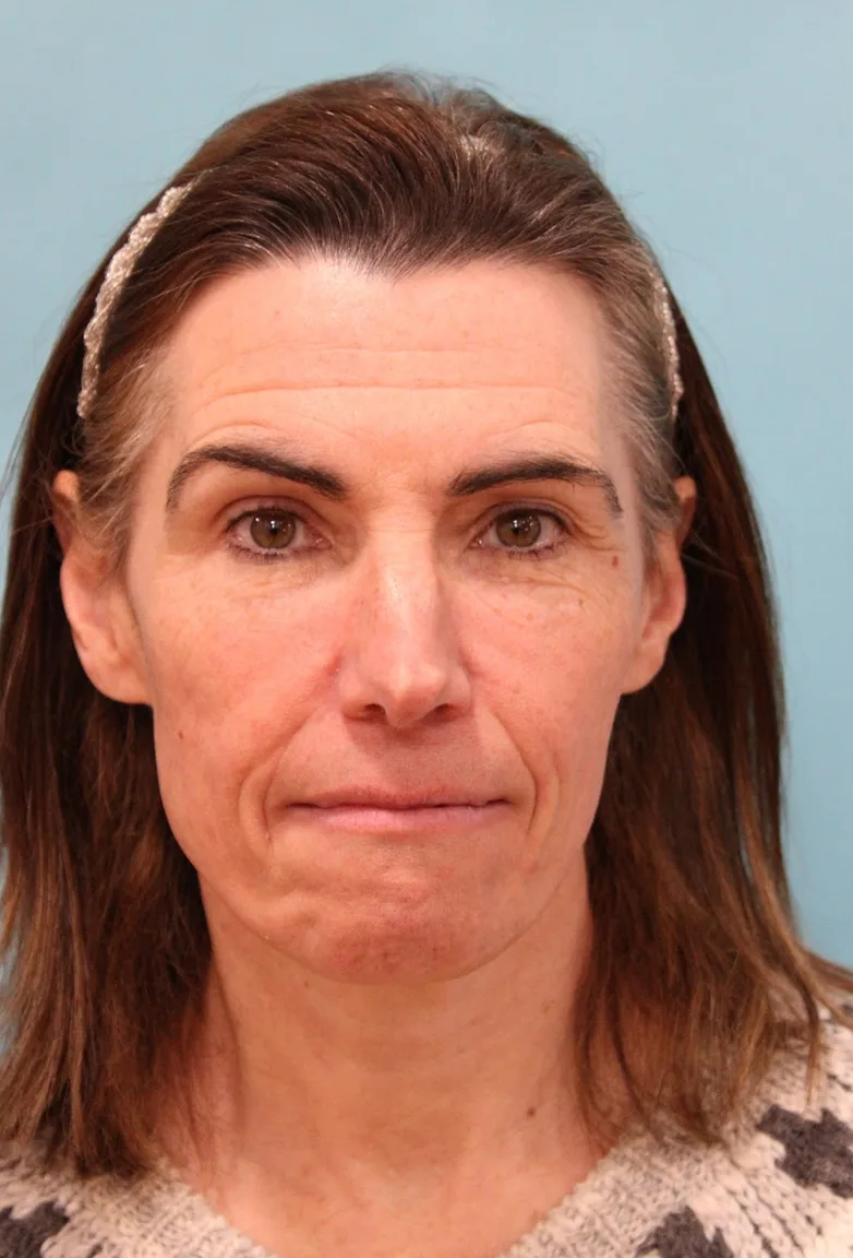 Laser Resurfacing Before & After Patient #5225