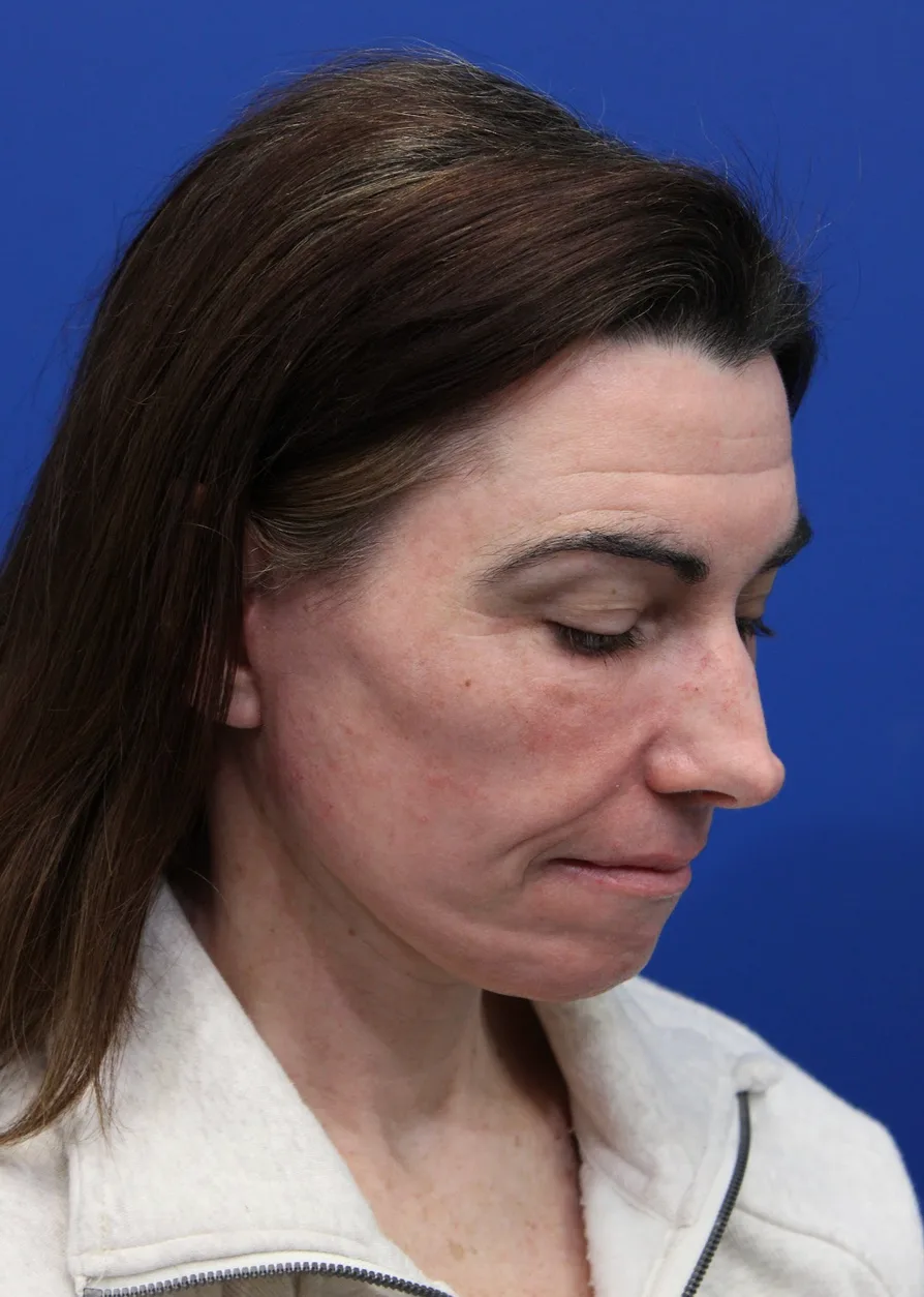 Facelift Before & After Patient #5227