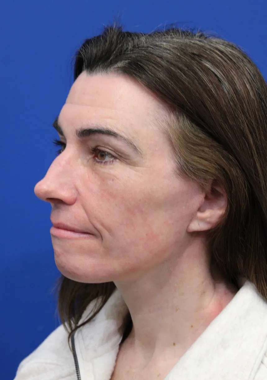 Facelift Before & After Patient #5227
