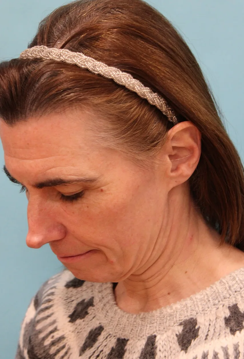 Facelift Before & After Patient #5227