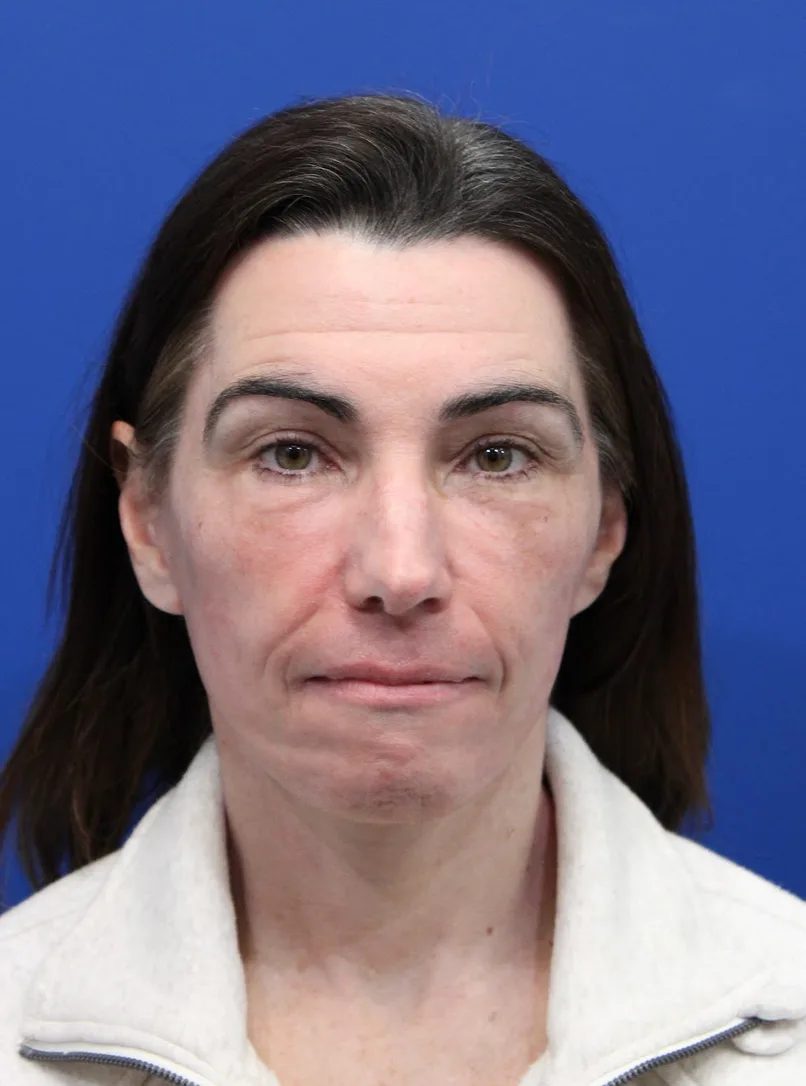 Laser Resurfacing Before & After Patient #5225