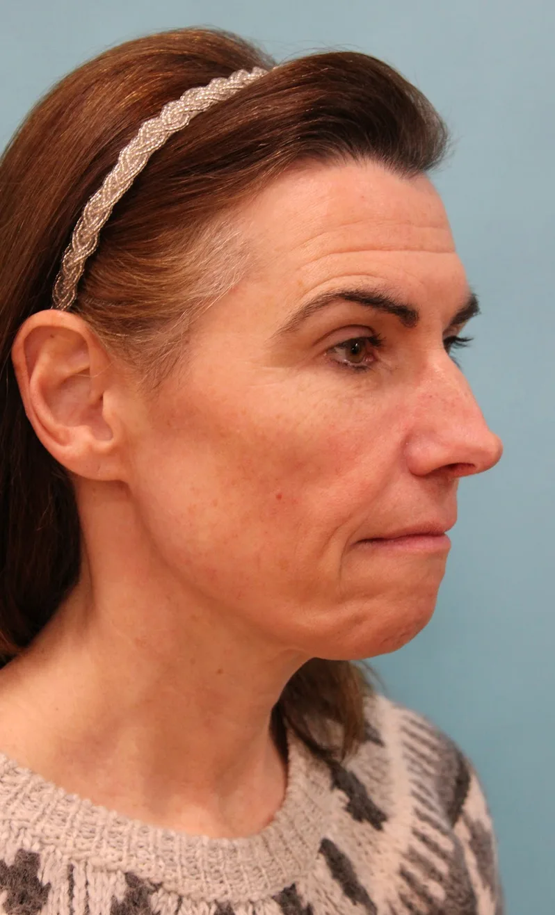 Laser Resurfacing Before & After Patient #5225