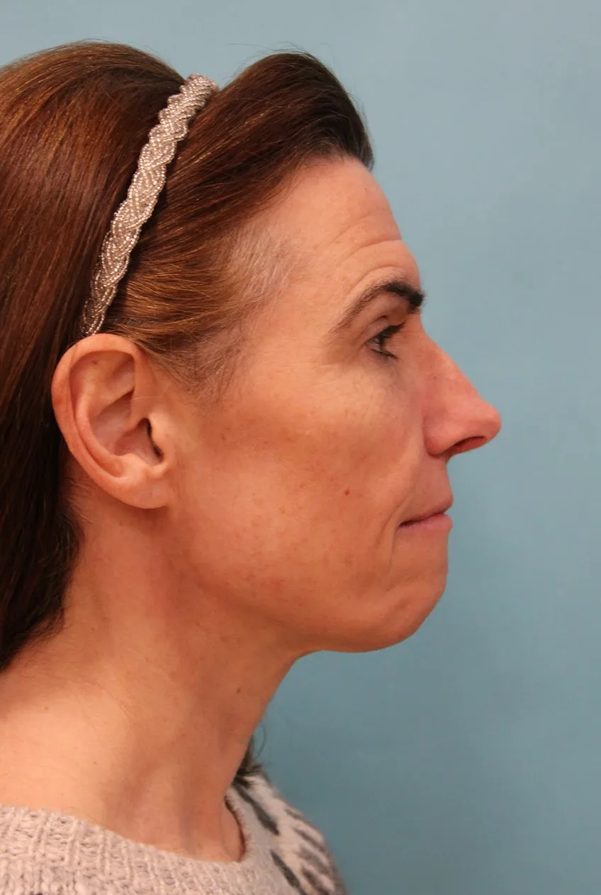 Facelift Before & After Patient #5227