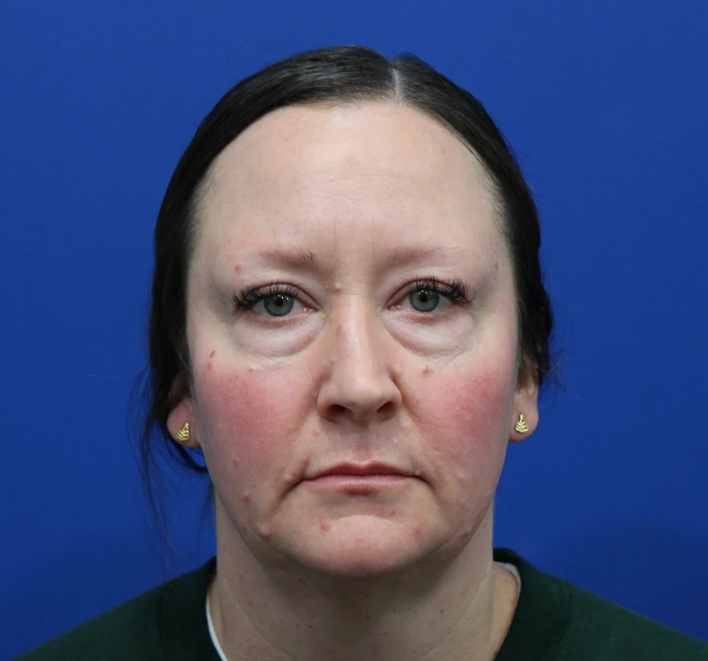 Lower Blepharoplasty Before & After Patient #5228