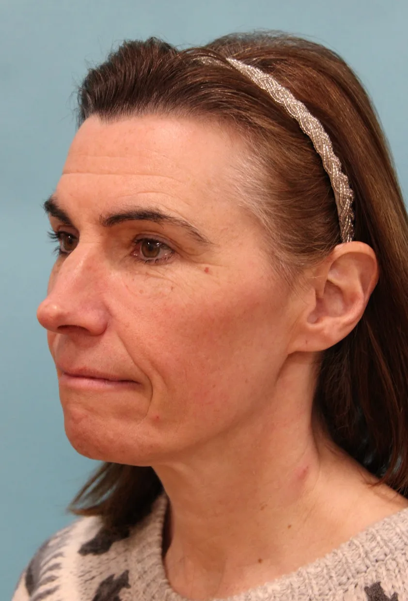 Brow Lift Before & After Patient #5226