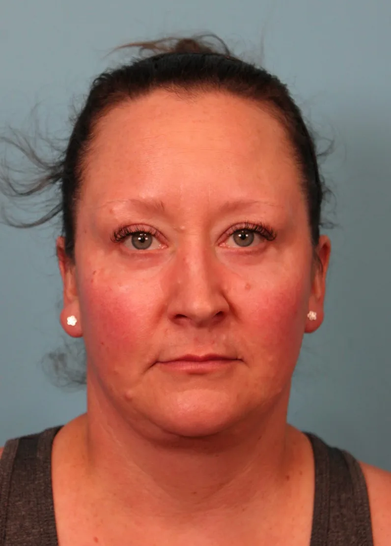 Lower Blepharoplasty Before & After Patient #5228