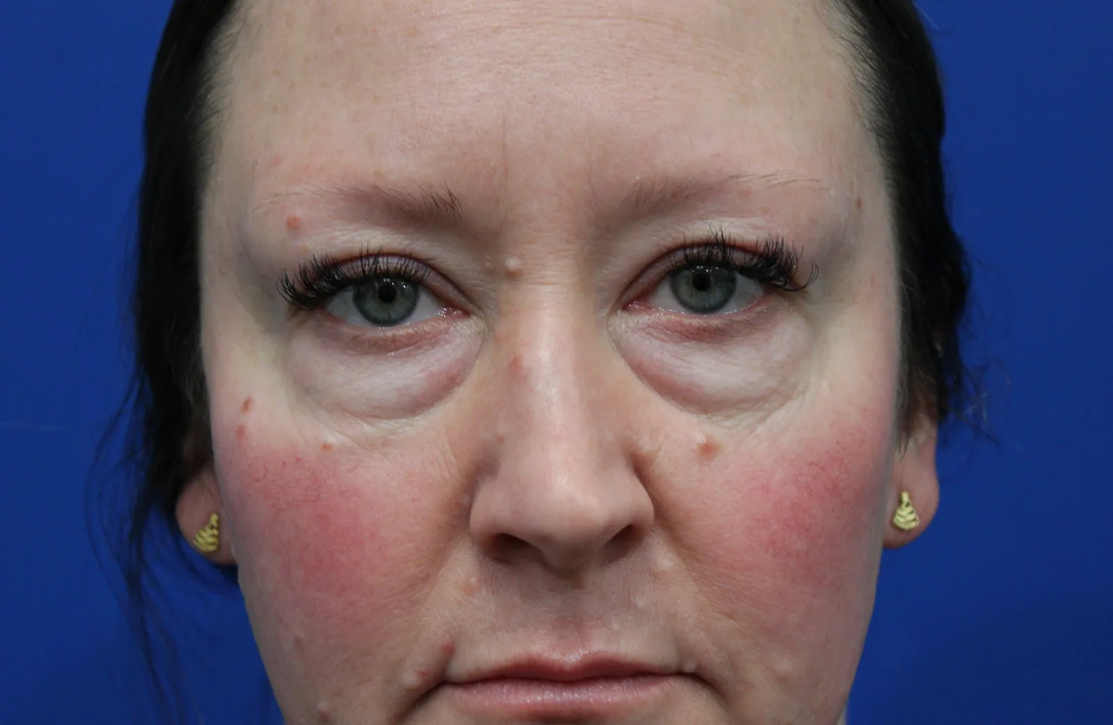 Lower Blepharoplasty Before & After Patient #5228