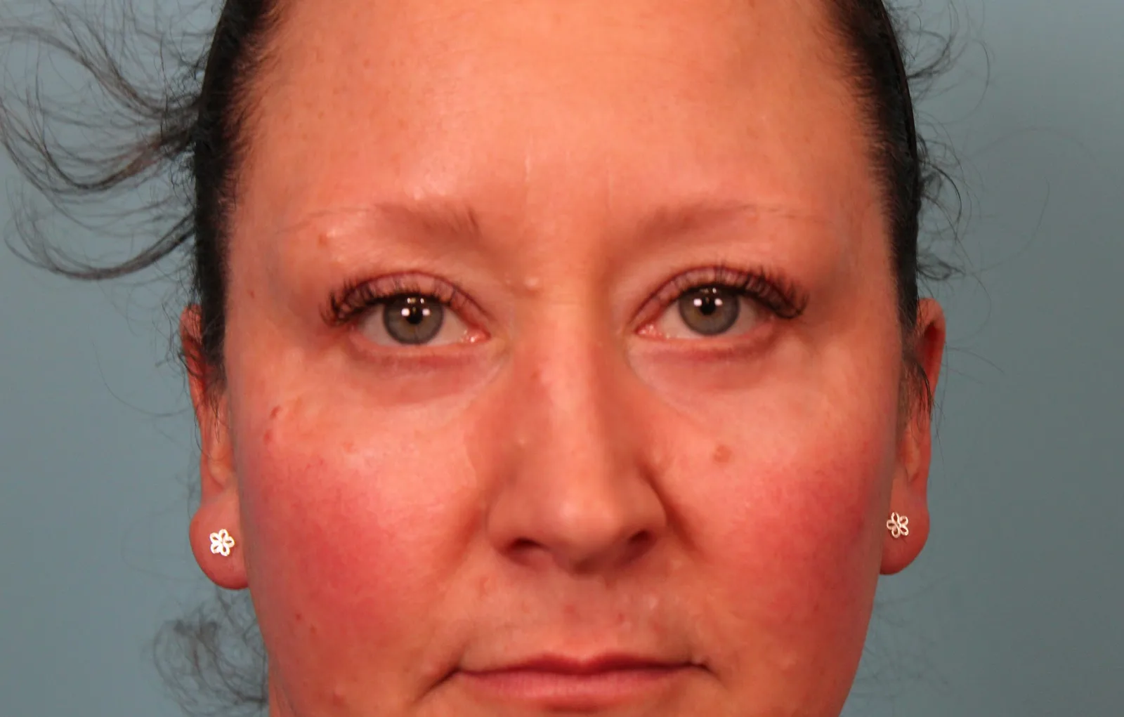 Lower Blepharoplasty Before & After Patient #5228