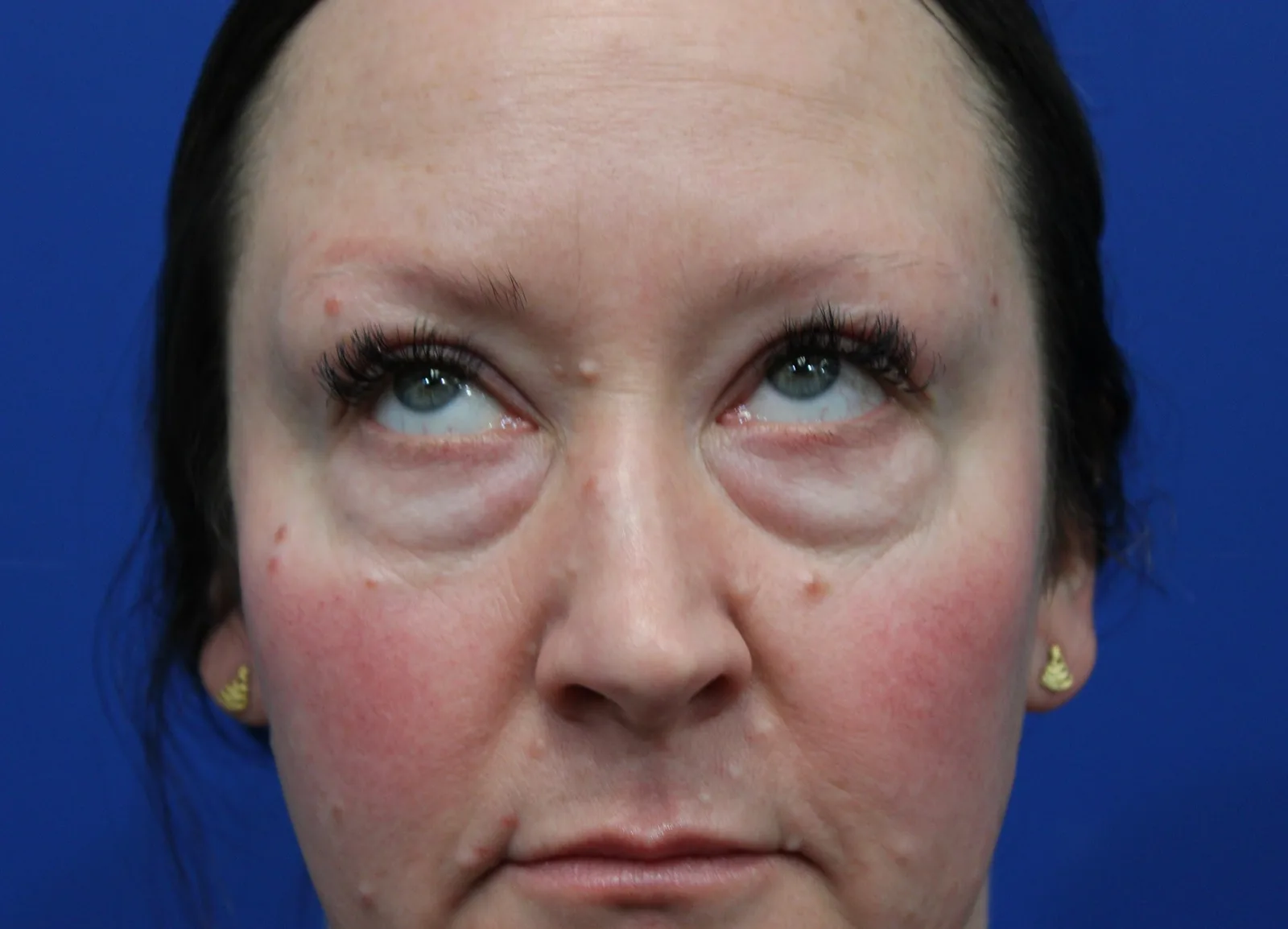 Lower Blepharoplasty Before & After Patient #5228