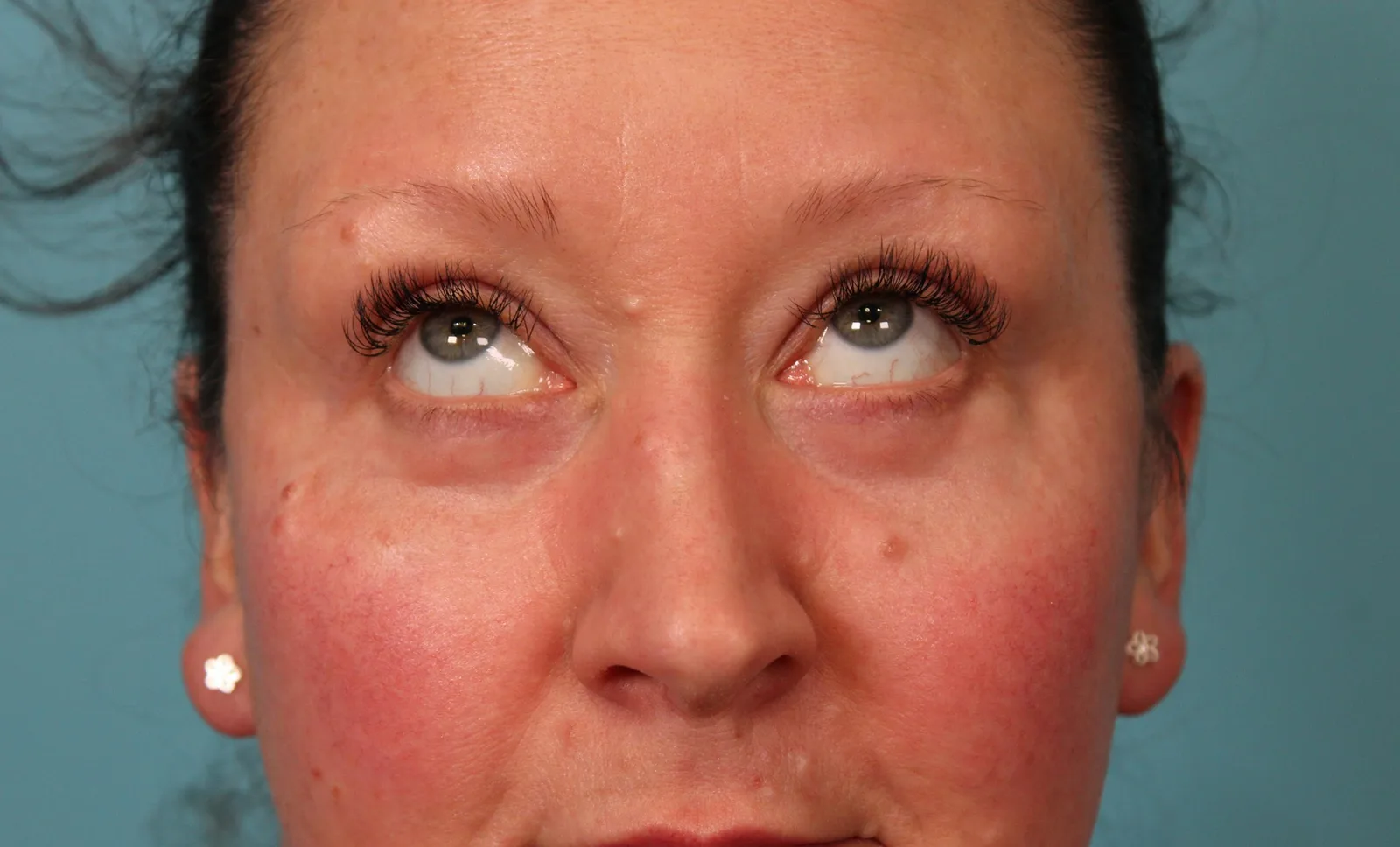 Lower Blepharoplasty Before & After Patient #5228