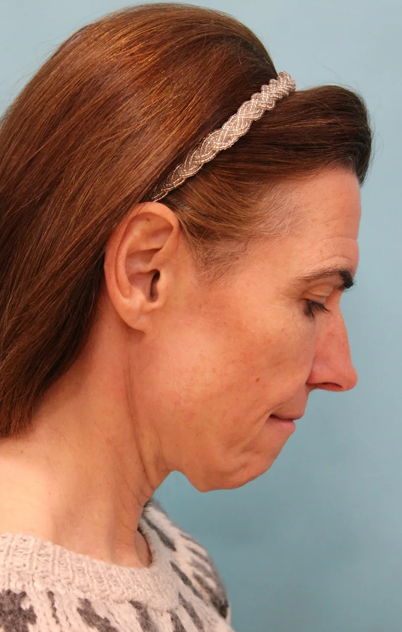 Facelift Before & After Patient #5227