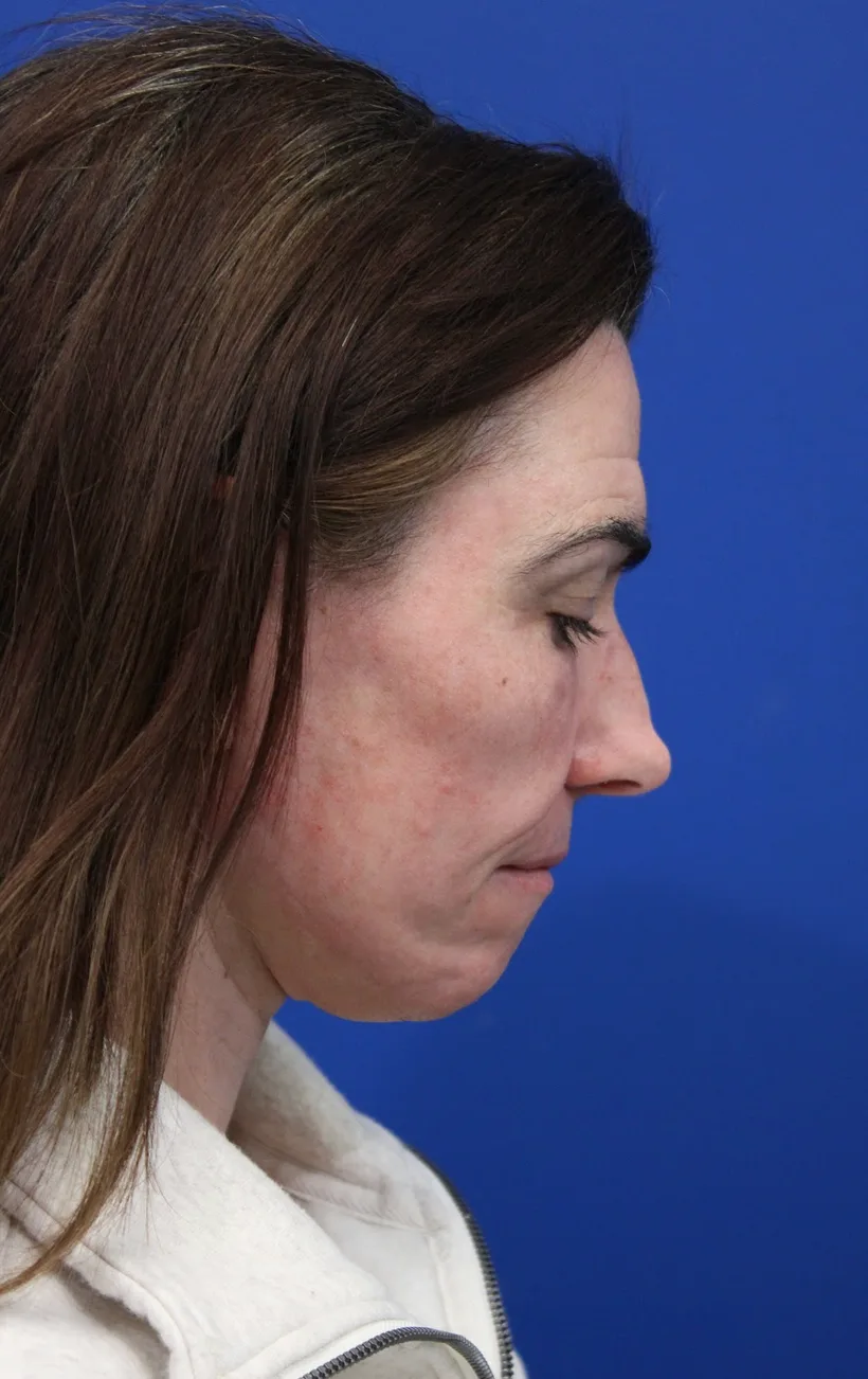 Facelift Before & After Patient #5227