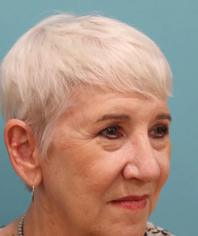 Upper Blepharoplasty Before & After Patient #5470