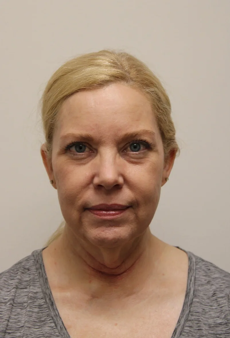 Facelift Before & After Patient #5277