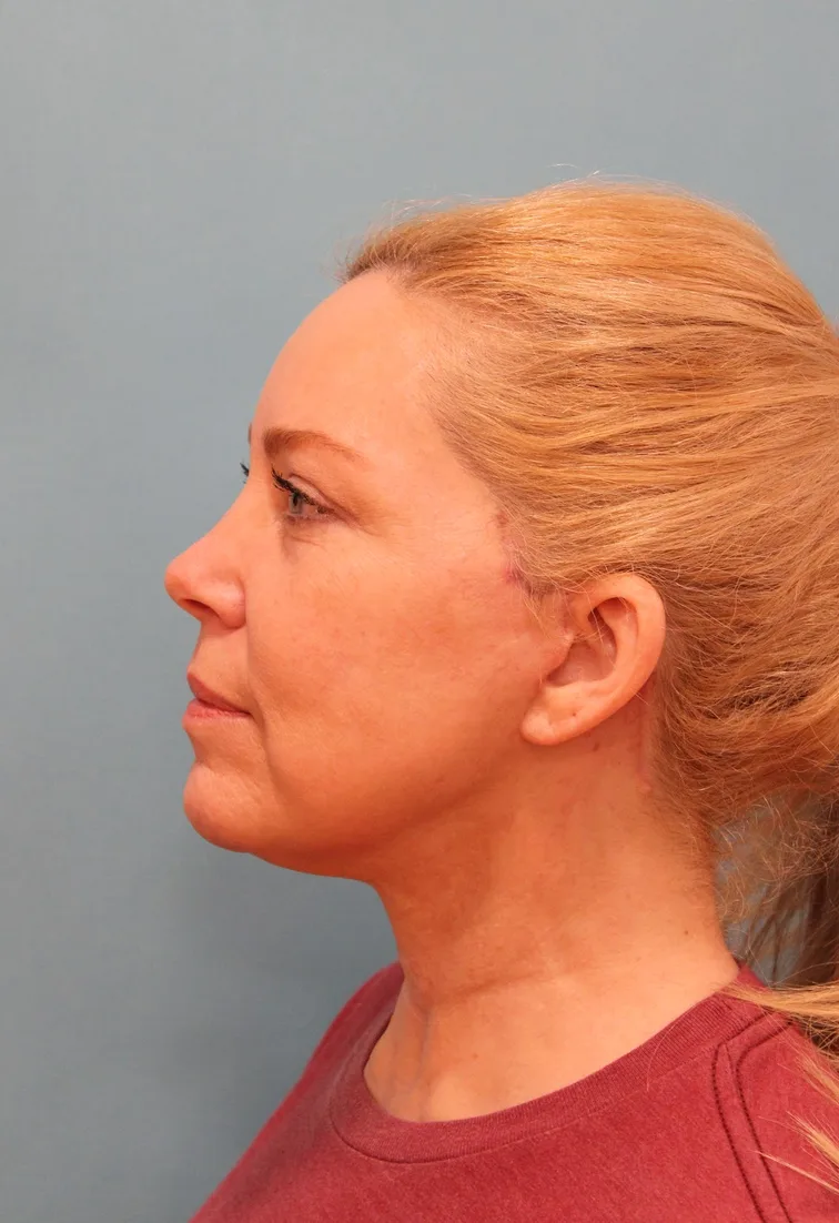 Facelift Before & After Patient #5277