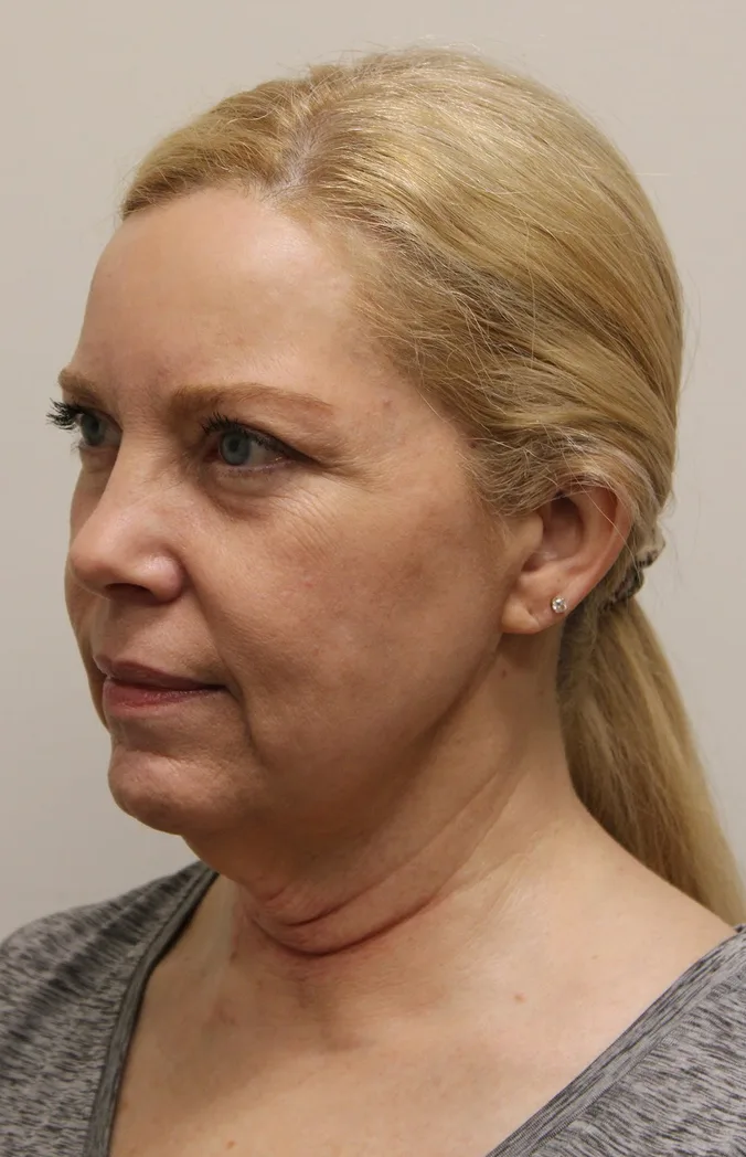 Facelift Before & After Patient #5277