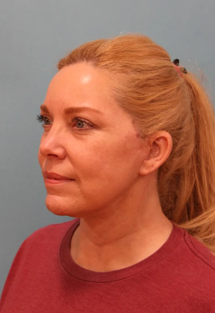 Facelift Before & After Patient #5277