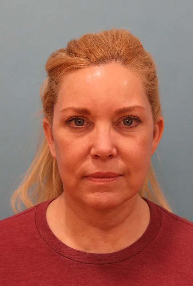 Facelift Before & After Patient #5277