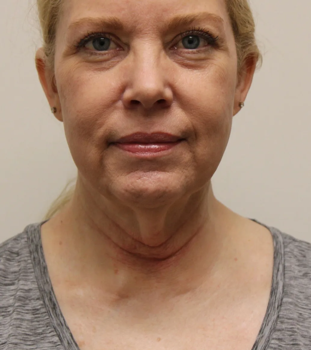 Facelift Before & After Patient #5277