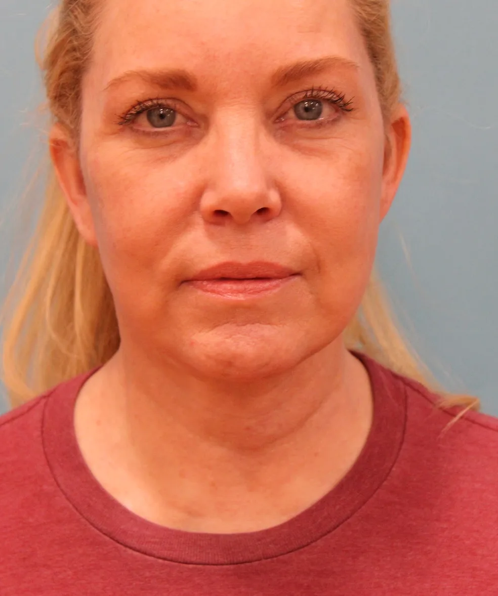 Facelift Before & After Patient #5277