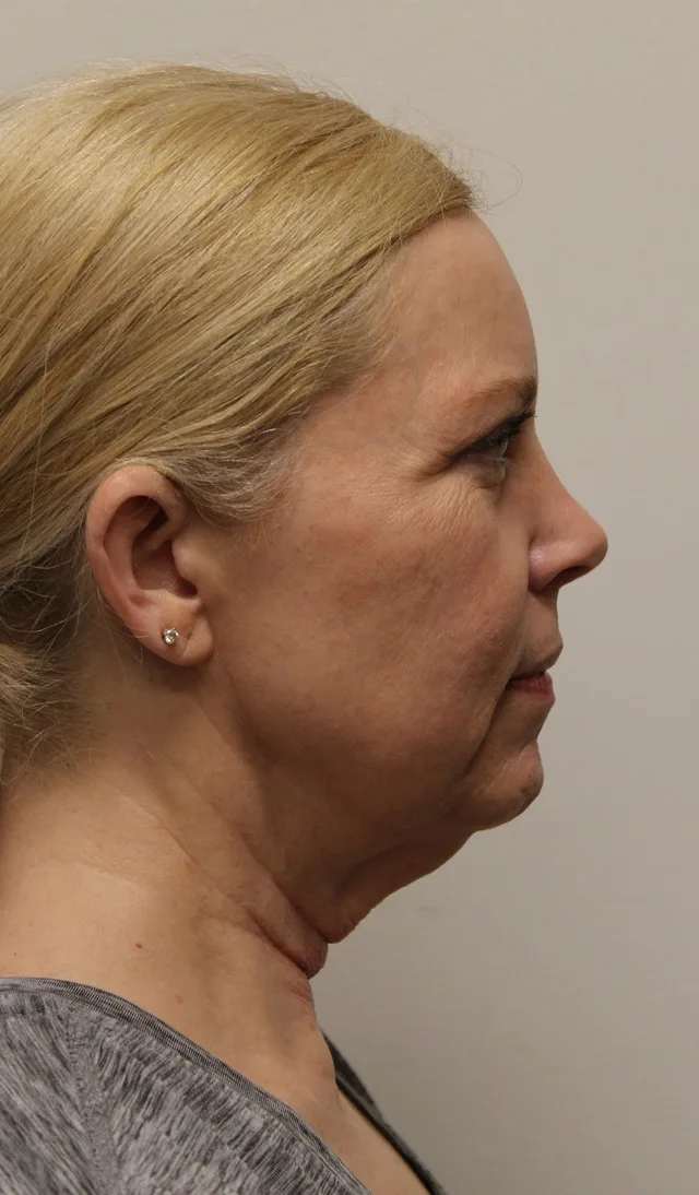 Facelift Before & After Patient #5277