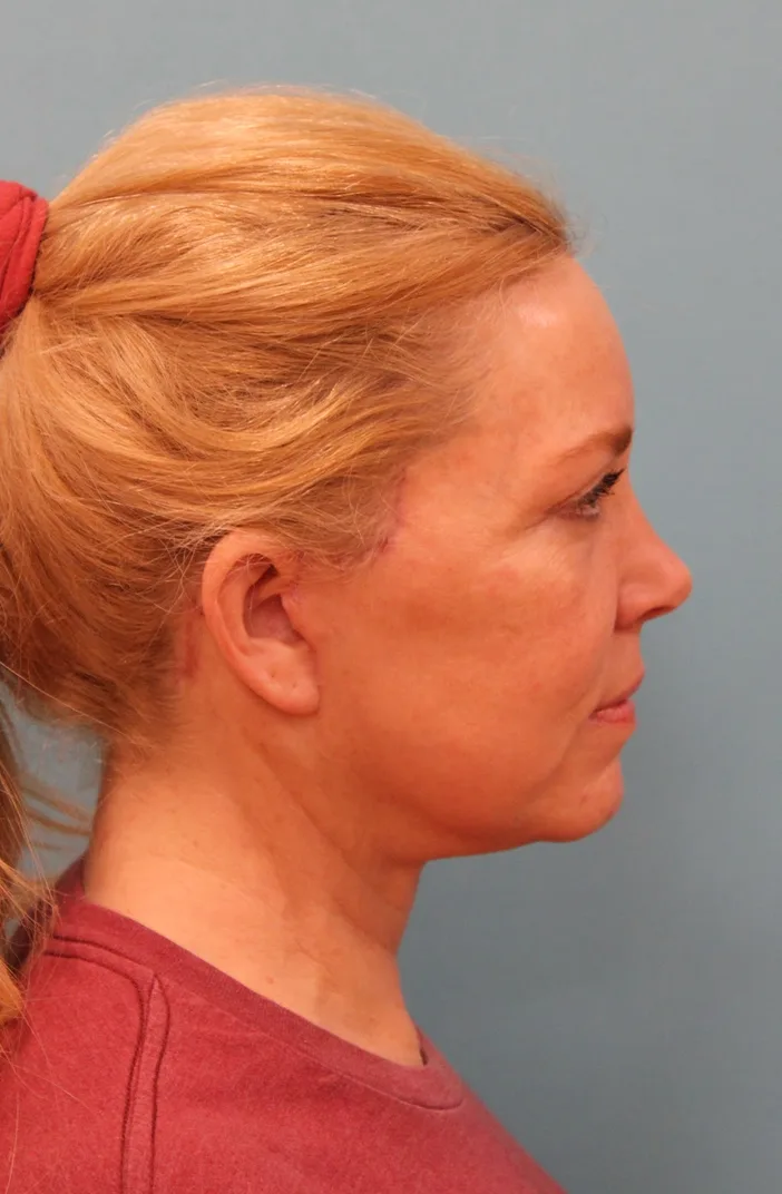 Facelift Before & After Patient #5277
