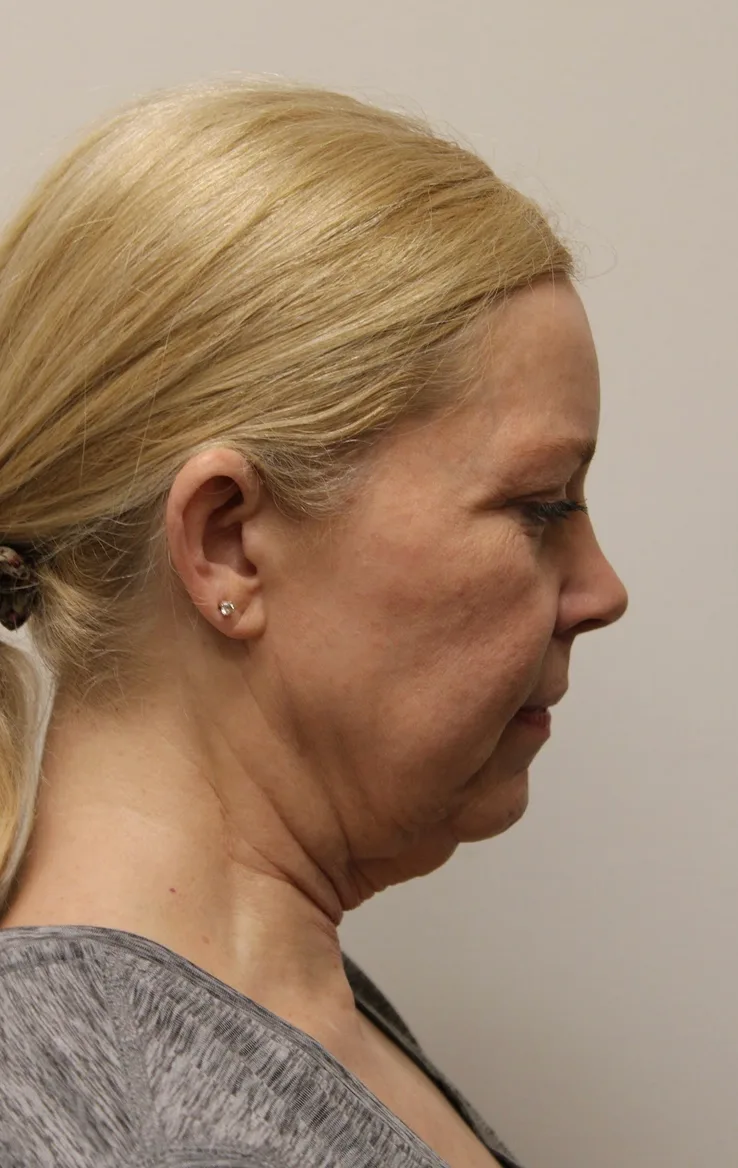Facelift Before & After Patient #5277