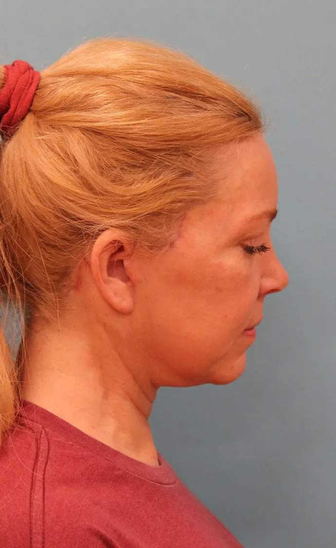 Facelift Before & After Patient #5277