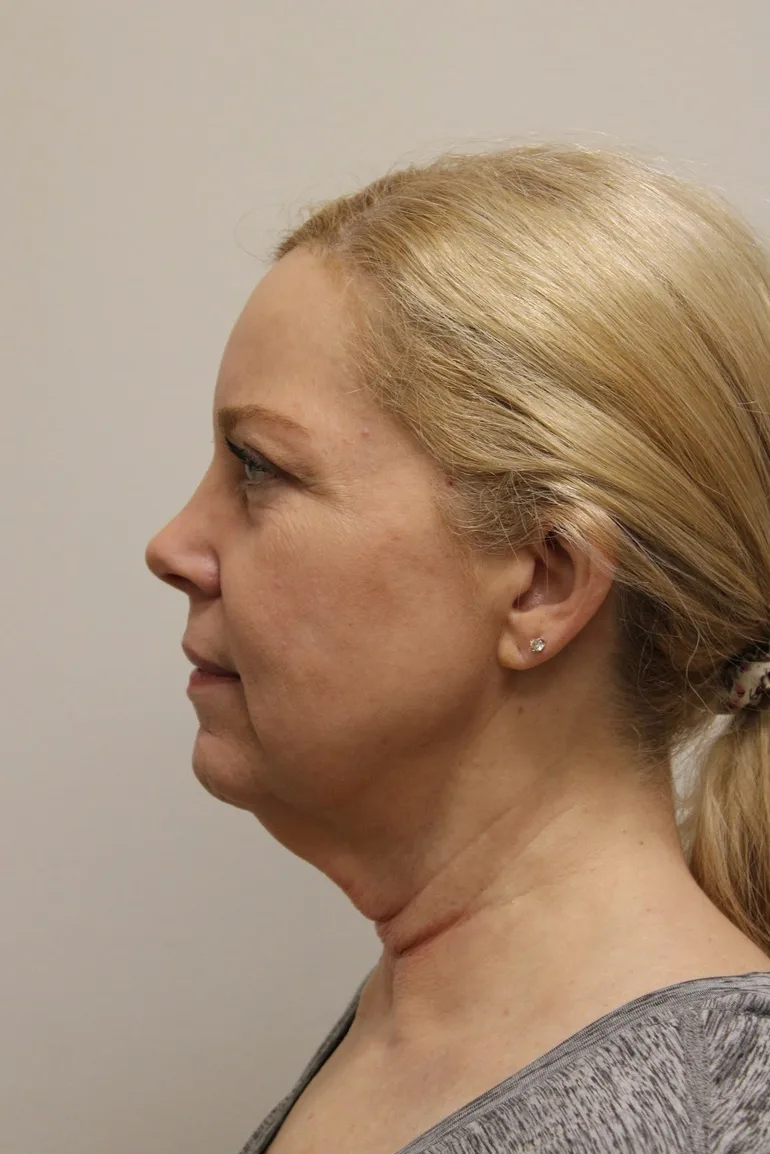 Facelift Before & After Patient #5277