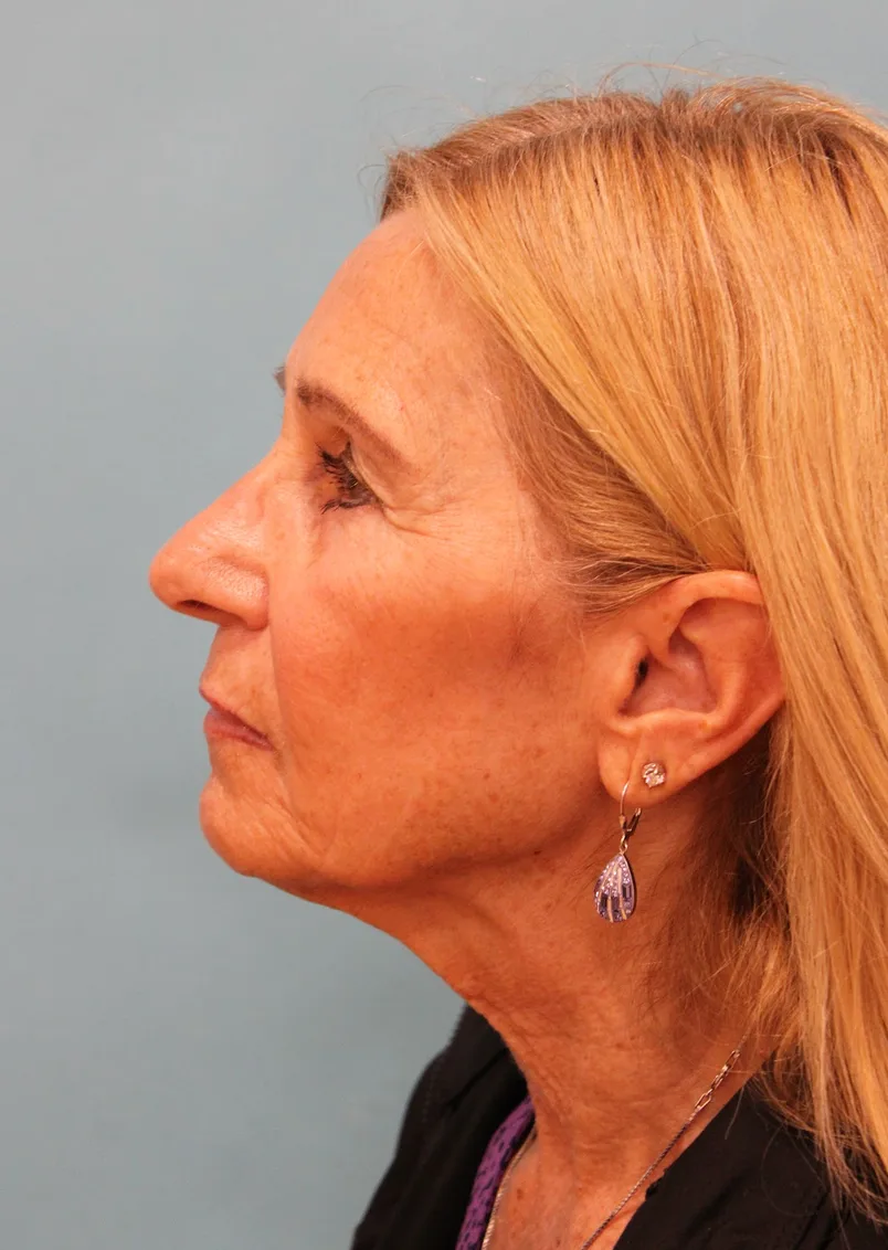 Facelift Before & After Patient #5278
