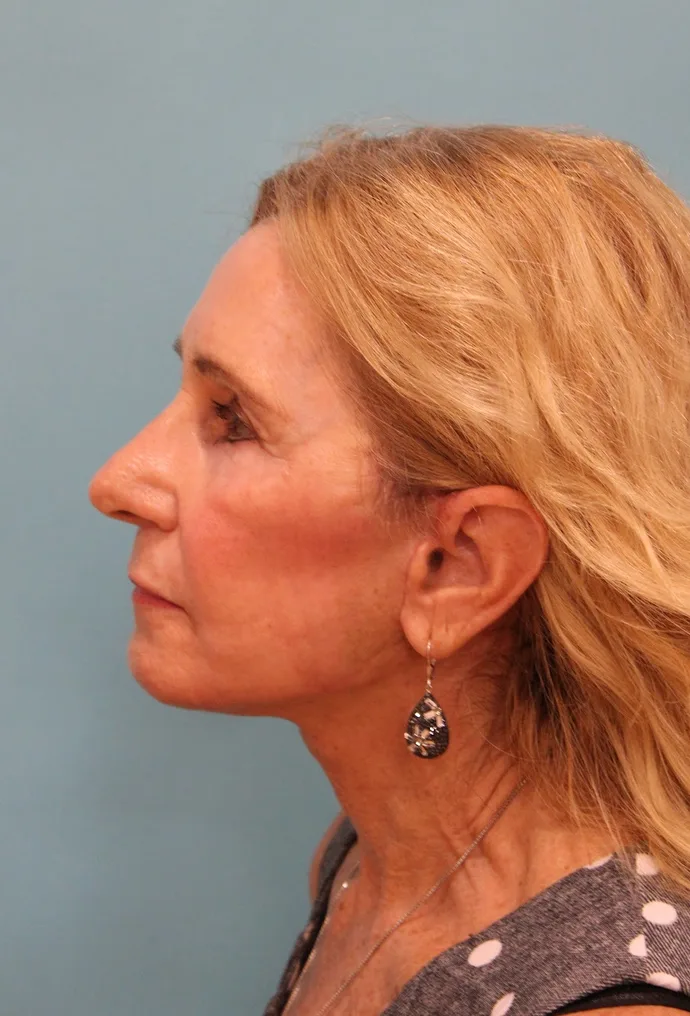 Facelift Before & After Patient #5278
