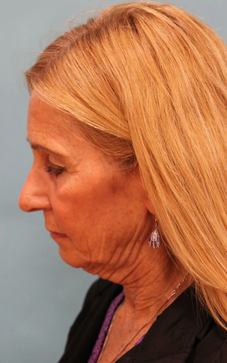 Facelift Before & After Patient #5278