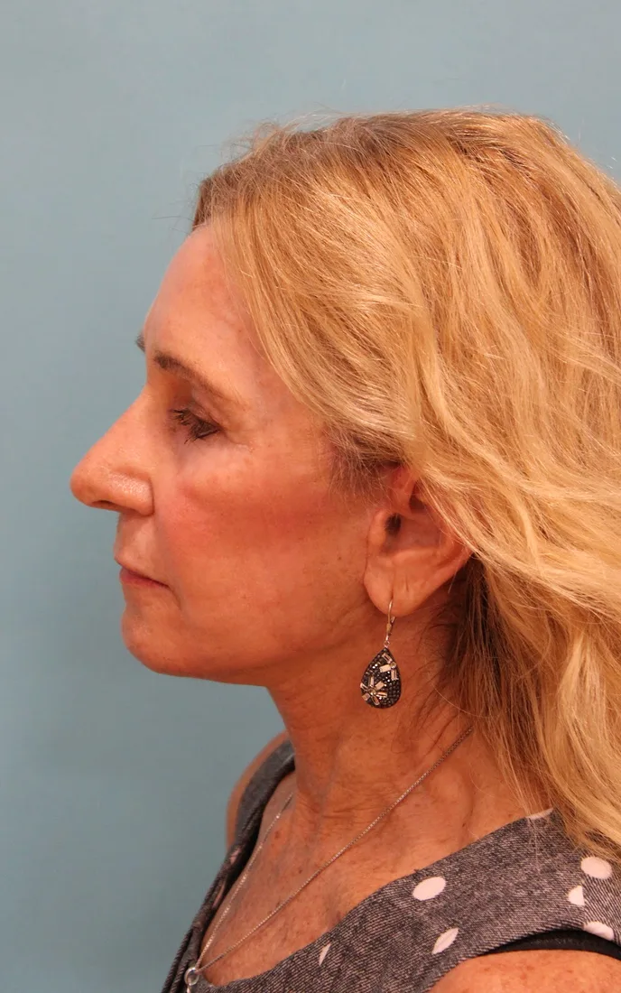 Facelift Before & After Patient #5278