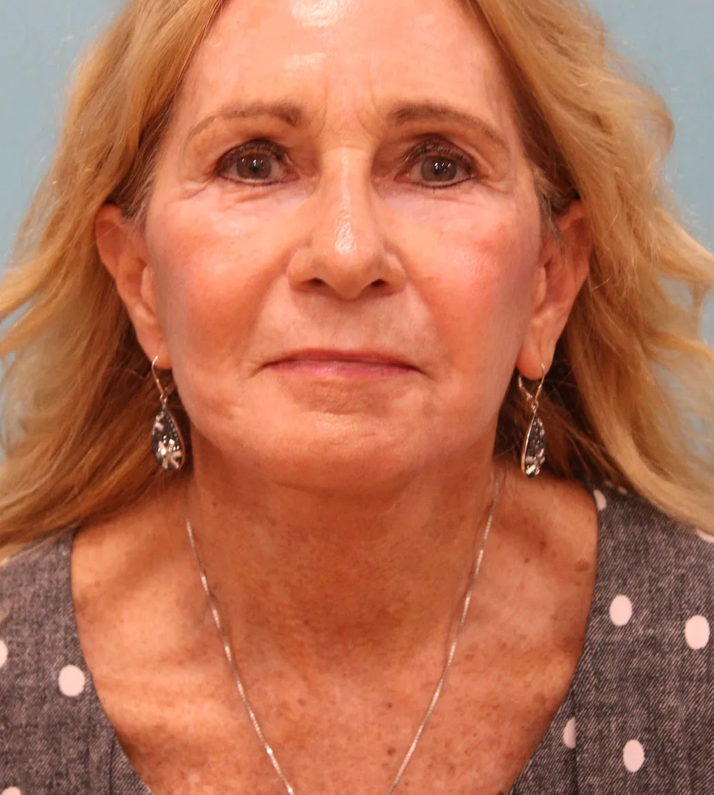Facelift Before & After Patient #5278