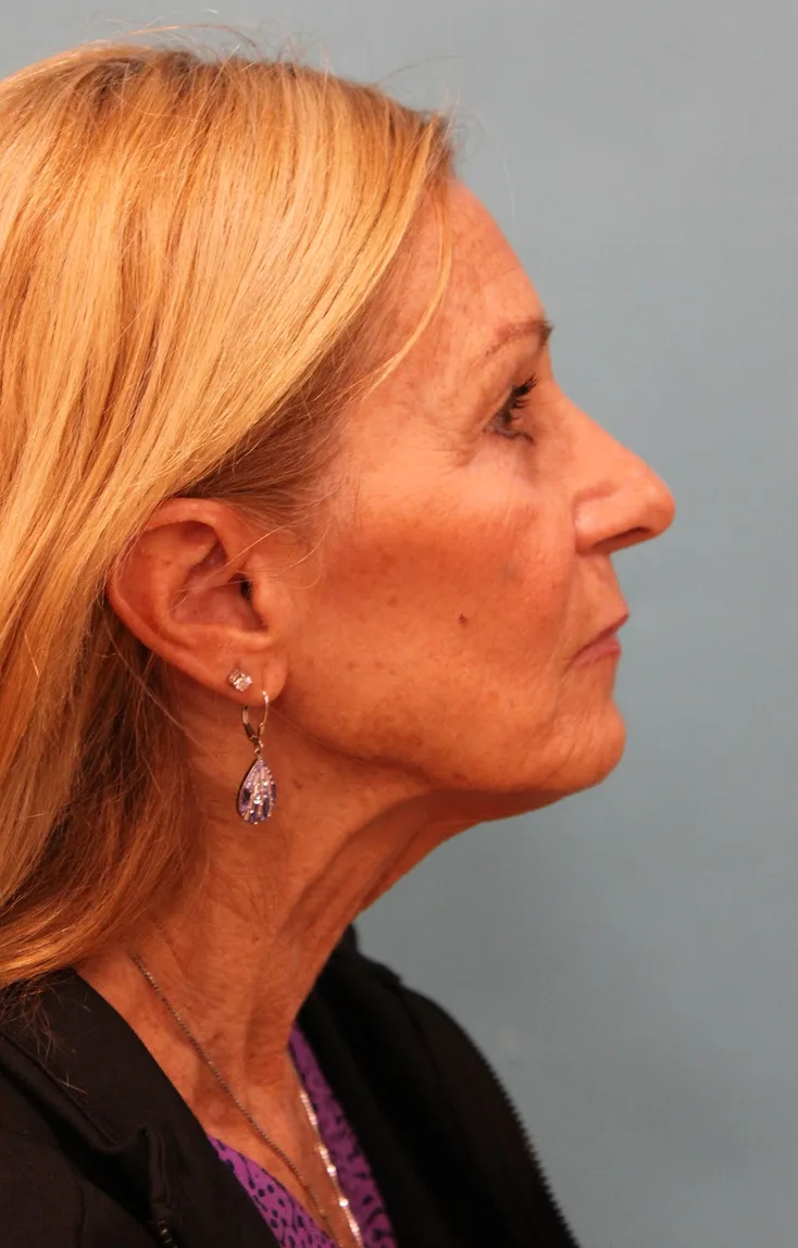 Facelift Before & After Patient #5278