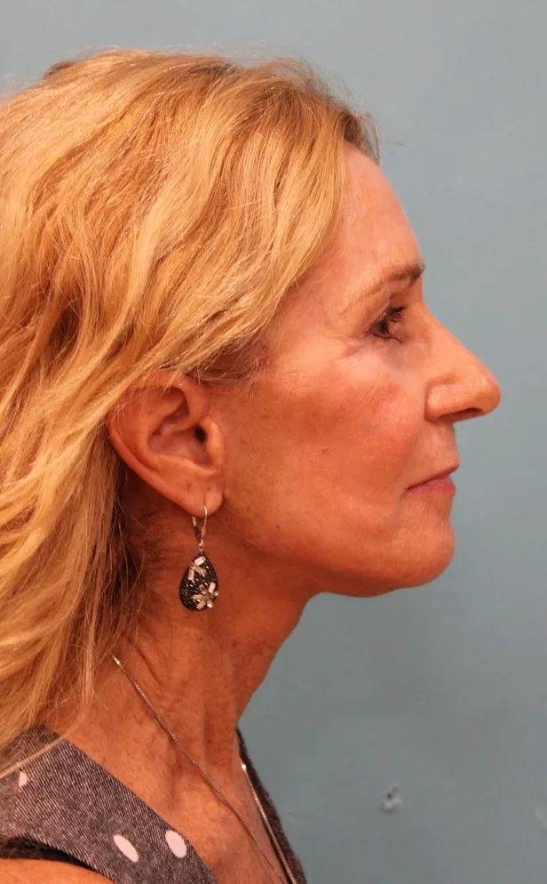 Facelift Before & After Patient #5278