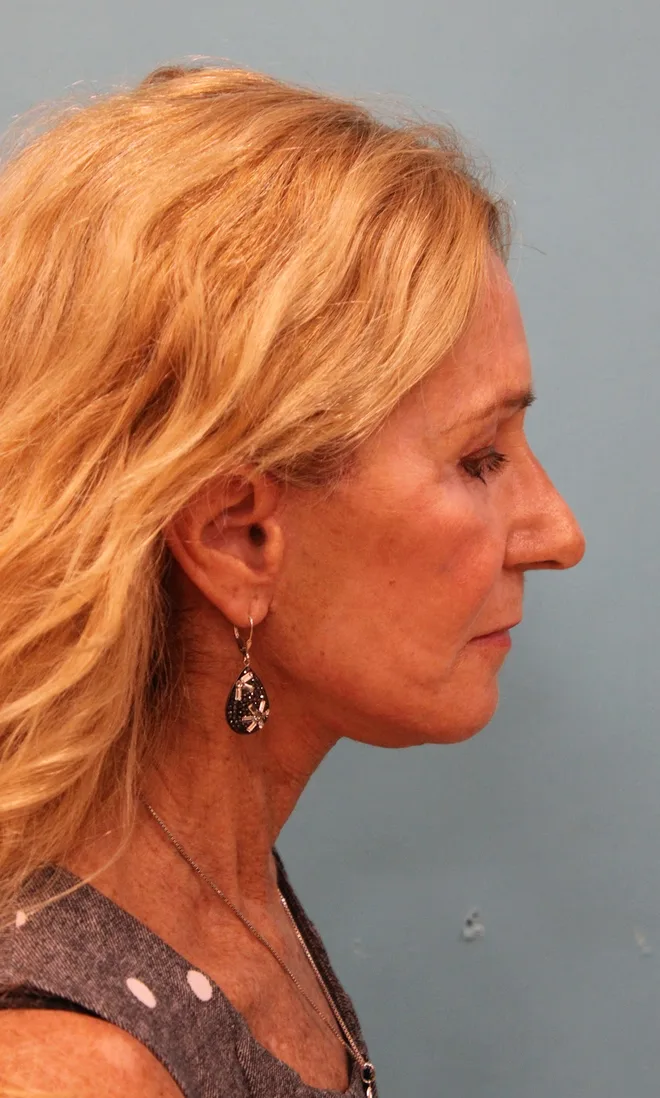 Facelift Before & After Patient #5278