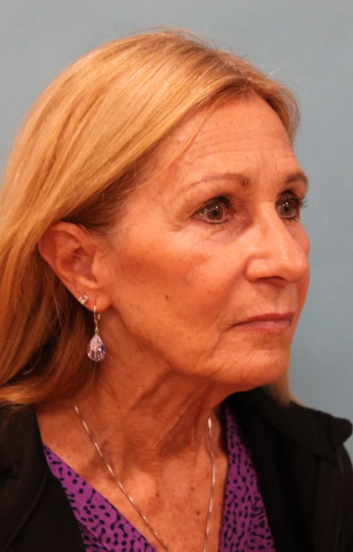 Facelift Before & After Patient #5278