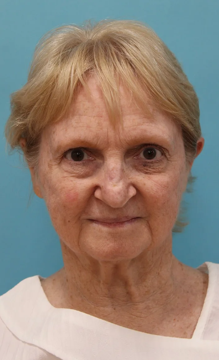 Facelift Before & After Patient #5279