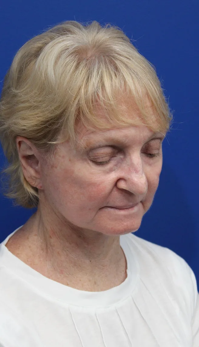 Facelift Before & After Patient #5279